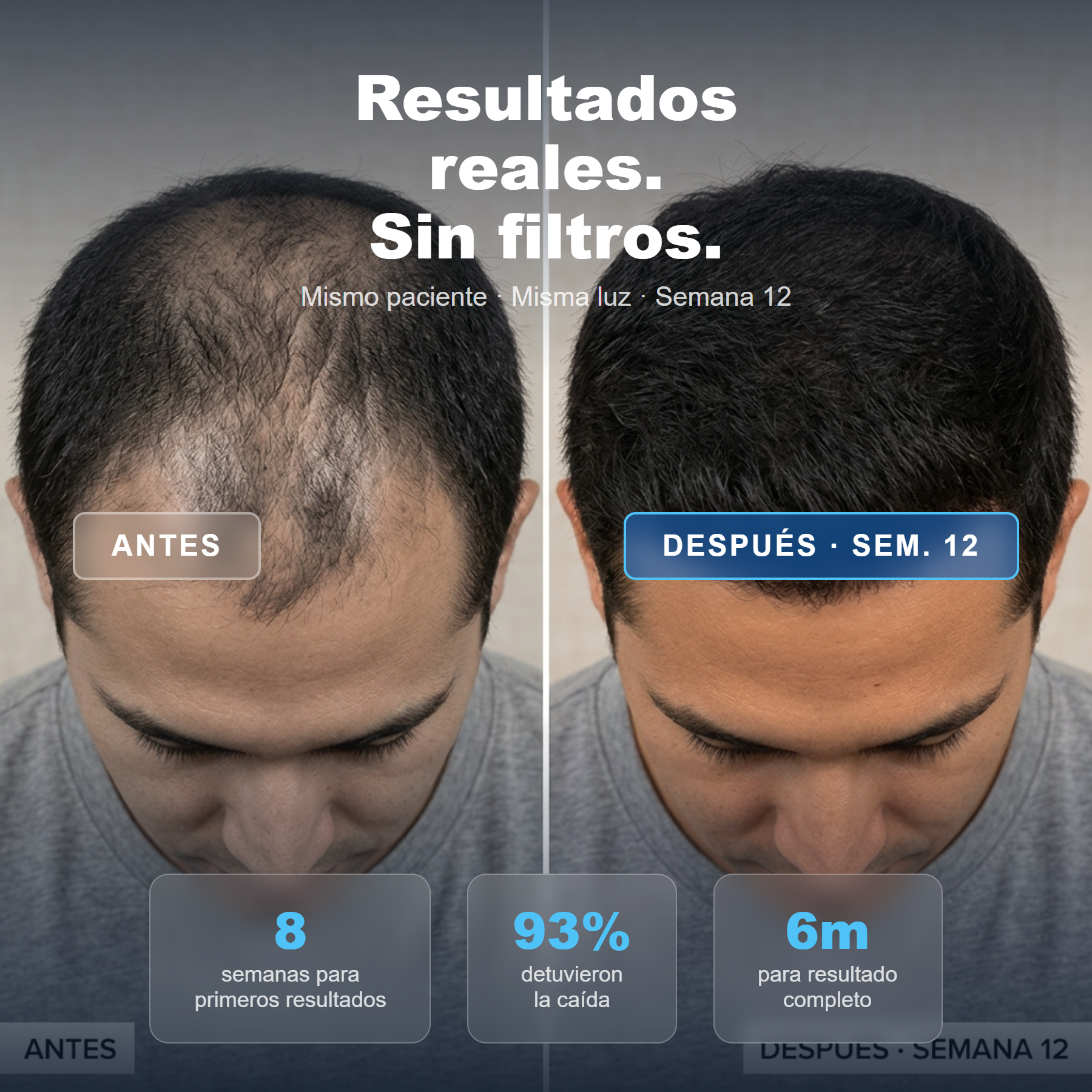 ELLOS™ Cabello Para el DHT. Finasteride + Minoxidil + Biotina. Recupera tu cabello hoy. - Imagen 4